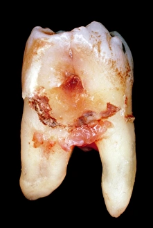 Oral Health Care Drucke: Extracted molar