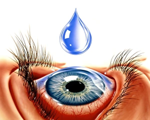 Drucke von Konjunktivitis. Kunstwerk eines Augentropfes hinzugefügt an einem Auge mit Konjunktivitis Bilder Datiert 2002 März: Aug mit Konjunktivitis