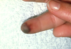 Bilder, datiert 1999: Zungfinger des Patienten mit peripherer Vasokonstriktion