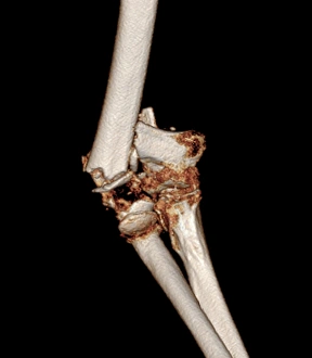 Gerahmter Druck : Verletzter Ellenbogen, CT-Scan Gerahmter Druck : Verletzter Ellenbogen, CT-Scan