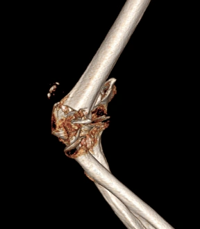 3D CT Scan Images Drucke: Fractured elbow, CT scan