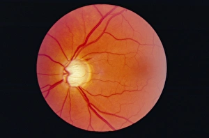 Glaucoma
