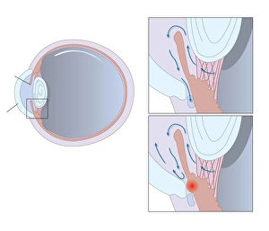 Glaucoma Treatment Drucke: Glaucoma, artwork