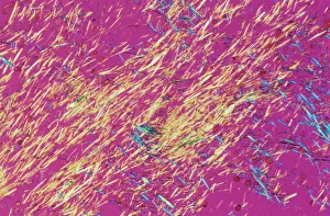 Polarisiertes Licht Drucke: Rötliche Kristalle der Gicht