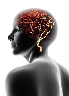 Migraine Symptoms Drucke: Headache, conceptual image