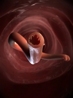 Intestinal Parasites Drucke: Hookworm, artwork