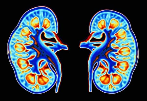 Human Kidney Anatomy Drucke: Human kidneys