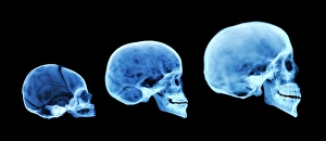 Drucke von Menschliche Schädelentwicklung. Farbige Röntgenaufnahme von drei menschlichen Gehirnshalen, einschließlich eines Neugeborenen, einem Kind und einem Erwachsenen Bilder Datiert 2006 April: Menschlicher Schädelentwicklung