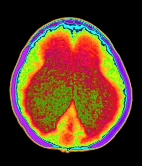 Drucke von Hydrozephalus. Farbgesteuertes Computertomographie (CT)-Bild eines axialen Schnitts durch das Gehirn eines Kindes mit Hydrozephalus (Wasser im Gehirn) Bilder Datiert 2000 Juni: Hy hydrozephalus RCT-Scans