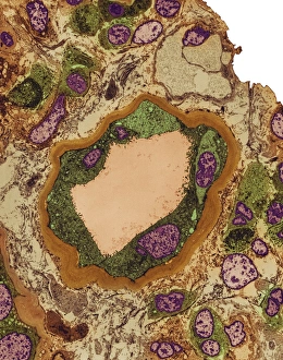 Coloured TEM Images Drucke: Hydronephrosis
