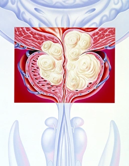 Drucke von Illumination einer benignen Prostatahyperplasie Bilder Datiert 2003 Januar: Illumination einer benignen Prostatahyperplasie