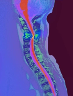 Entzündete Wirbelsäulenröhren mit MRI-Scans