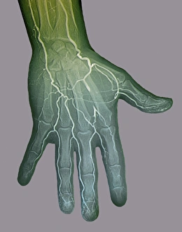 Bilder Datiert 2015: Ischämie, digitale Angiographie