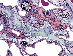 Drucke von Nierenkrankheit. Farbige Transmissionselektronenmikroskopaufnahme (TEM) einer Schnittstelle durch den Glomerulus eines Nierengewebs mit Membranopathie Bilder Datiert 2006 August: Nierenkrankheit, TEM