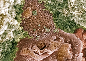 Drucke von Nierenglomerulusoberfläche. Farbige Rasterelektronenmikroskopaufnahme (SEM) von Podozytenzellen (Orangefarben) auf der Oberfläche eines Nierenglomeruluses Bilder Datiert 2009 März: Nierenglomerulat Oberfläche, SEM