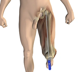 Osteoarthritis Treatment Options Drucke: Knee replacement alignment, artwork