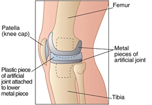 Osteoarthritis Treatment Drucke: Knee replacement, artwork