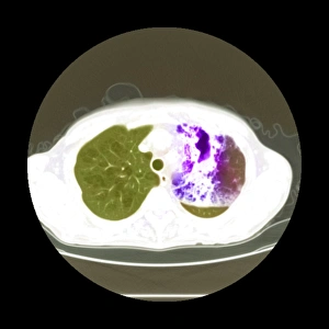 Lungenabszess, CT-Scan