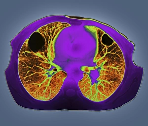 Gerahmter Druck : Lungenabszess, CT-Scan Gerahmter Druck : Lungenabszess, CT-Scan