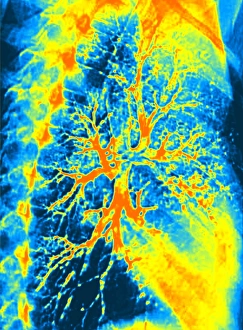 Lung Anatomy Drucke: Lung bronchogram, coloured X-ray