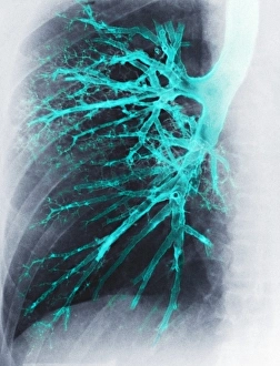 Respiratory System Diagram Drucke: Lung, X-ray
