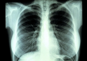 Human Respiratory System Anatomy Drucke: Lungs, X-ray