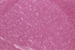 Lymphknotenhyperplasie, Leichtmikroskop C015/6224