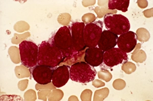 Bilder Datiert 22. Februar 2013: Lymphoblastisches Sarkom, Leuchtmikroskopische Abbildung