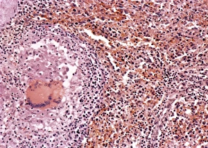 Mycobacterium Tuberculosis Bacteria Drucke: Miliary tuberculosis, light micrograph
