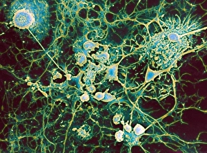 Bilder Datiert 2012 April: Mehrmalige Sklerose mit dem Enzymboden Myelin (SEM)
