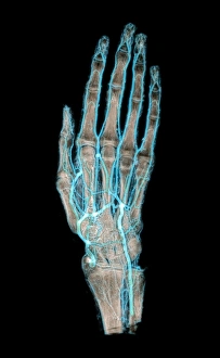 Drucke von Ein mumifiziertes Handgelenk. Farbige Angiogramm eines eingemummelten Hands showing die gesicherten und intakten Blutgefäße Bilder Datiert 2004 Dezember: Vermummelte Hand