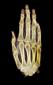 Coloured Medical Imaging Drucke: Mummified hand, X-ray