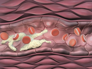 Atherosclerosis Drucke: Narrowed artery, artwork