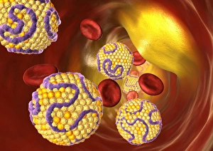 Drucke von Ein engere Arterie. Computerartwork einer engen Arterie, die rote Blutkörperchen (rot) und hohe Konzentration von niedrigdichte Lipoproteinen (LDL, gelbe Kugeln zeigen) Bilder Datiert 2008 März: Enge Blutgefäßsehne, Computerkunstwerk