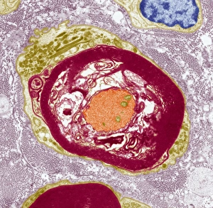 Schwann Cell Function Drucke: Nerve demyelination, TEM