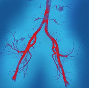 Bilder vom 26. Juni 2008: Normale Baucharterien, Angiogramm.