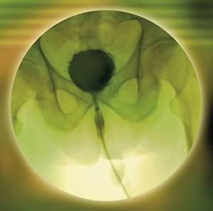 Normales Blasenbild, Cystogramm