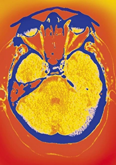 Brain Anatomy Images Drucke: Normal brain, CT scan