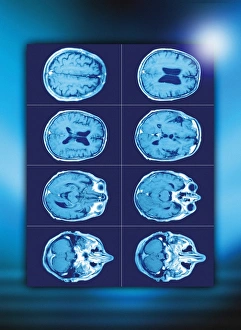 Normal Brain Anatomy Drucke: Normal brain, CT scans