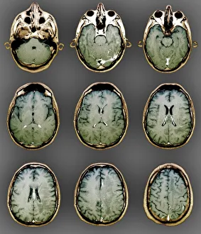 Bilder Datiert 2011: Normales Gehirn, MRT-Scans
