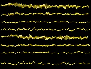 Medical Diagnostic Equipment Drucke: Normal EEG read out of the brains alpha waves