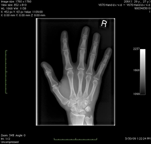 Röntgenbild Drucke: Normale Hand, digitales Röntgenbild