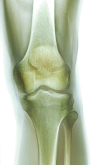 Drucke von Normal Kniegelenke mit farbiger Frontalröntgenaufnahme. Die Tibia und die kleinere Fibula verbinden sich am unteren Teil des Knies an den Femur, um das Gelenk zu bilden Bilder Datiert 2009 Mai: Normales Kniesband, Röntgenbild