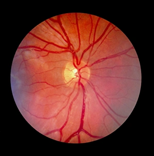 Drucke von Ein Fundusbild der Netzhaut eines normalen Auges zeigt die Verteilung von Venen und Arterien Bilder Datiert 2005 September: Normale Retina des Auges