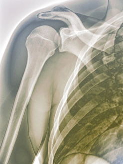 Drucke von Normales Schultergelenk, farbiges Röntgenbild der gesunden rechten Schulter eines 28-jährigen Patienten Bilder Datiert 2011 August: Normales Schultergelenk, Röntgenbild