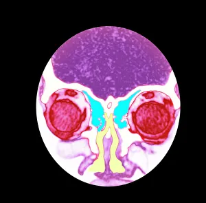 Drucke von Die Anatomie des Nasenrisses und der Sinus. Farbige Computertomographie (CT)-Bild von einem frontal angelegten Schnitt durch den Nasenneckel einer 31-jährigen Frau Bilder Datiert 2007 Januar: Rachen und Nasenlöcher, Computertomographie