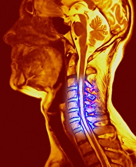 Drucke von Osteochondrose der Kollumenschwanzknochen aus linkseitiger Sicht: Computerartwork auf Basis einer Magnetresonanztomographie (MRT)-Bildung des Kolumenschwanzknöchens im Hals (blau) Bilder Datiert 2006 November: Weichteilchirurgische Erkrankung der Halsknochen
