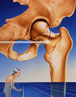 Osteoporosis Symptoms Drucke: Osteoporosis