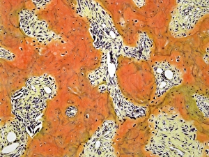 Light Microscopy Images Drucke: Pagets disease, light micrograph