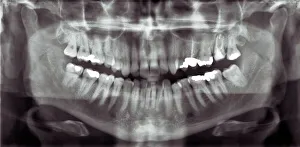 Drucke von Panoramische Zahn-X-Ray, der alle Zähne im Ober- und Unterkiefer zeigt Wissenschaftliche Poster: Panoramische Zahn-X-Ray